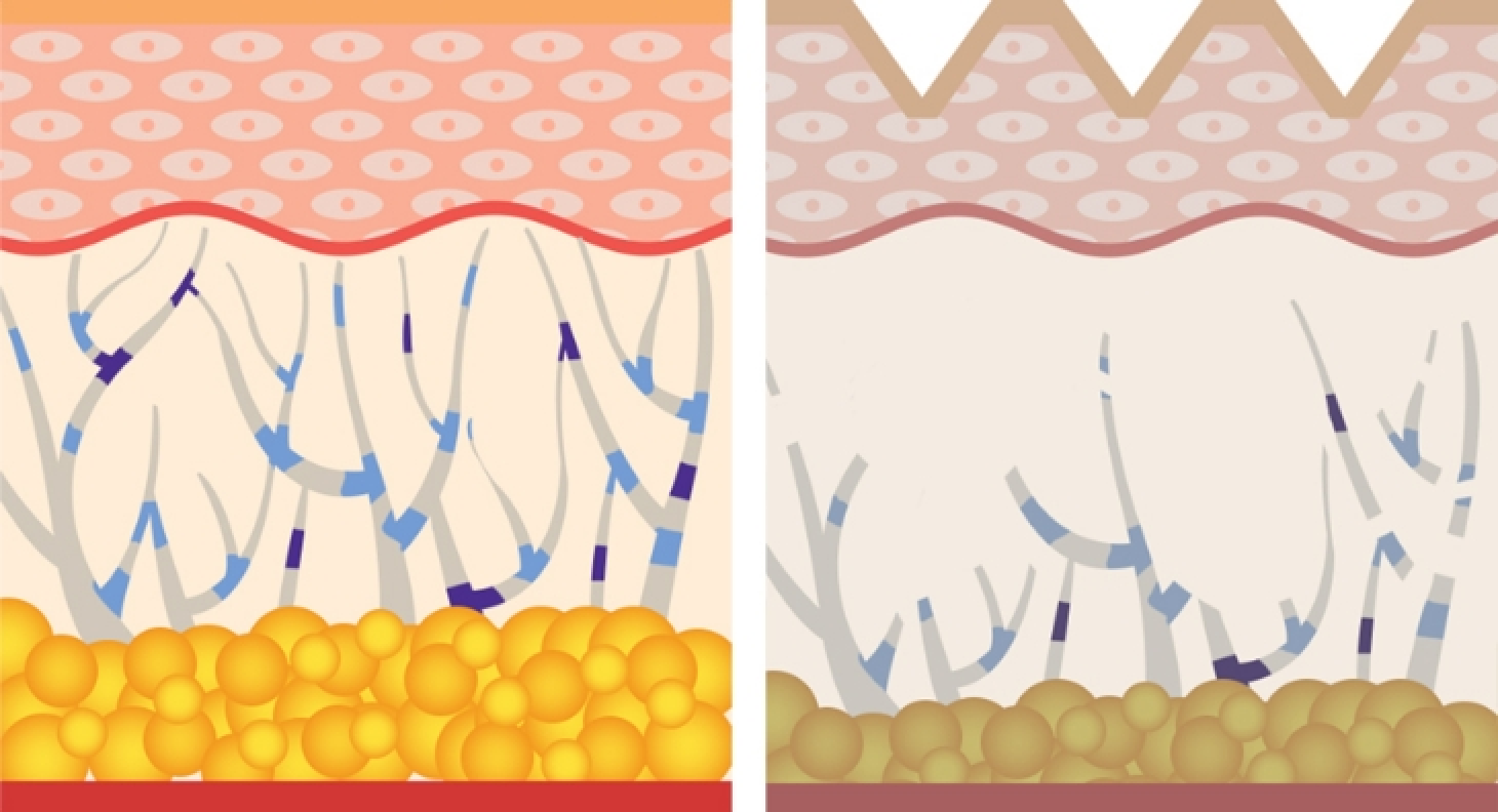 정상 피부층에 비해 적은 노화 피부층의 콜라겐, 히알루론산 양