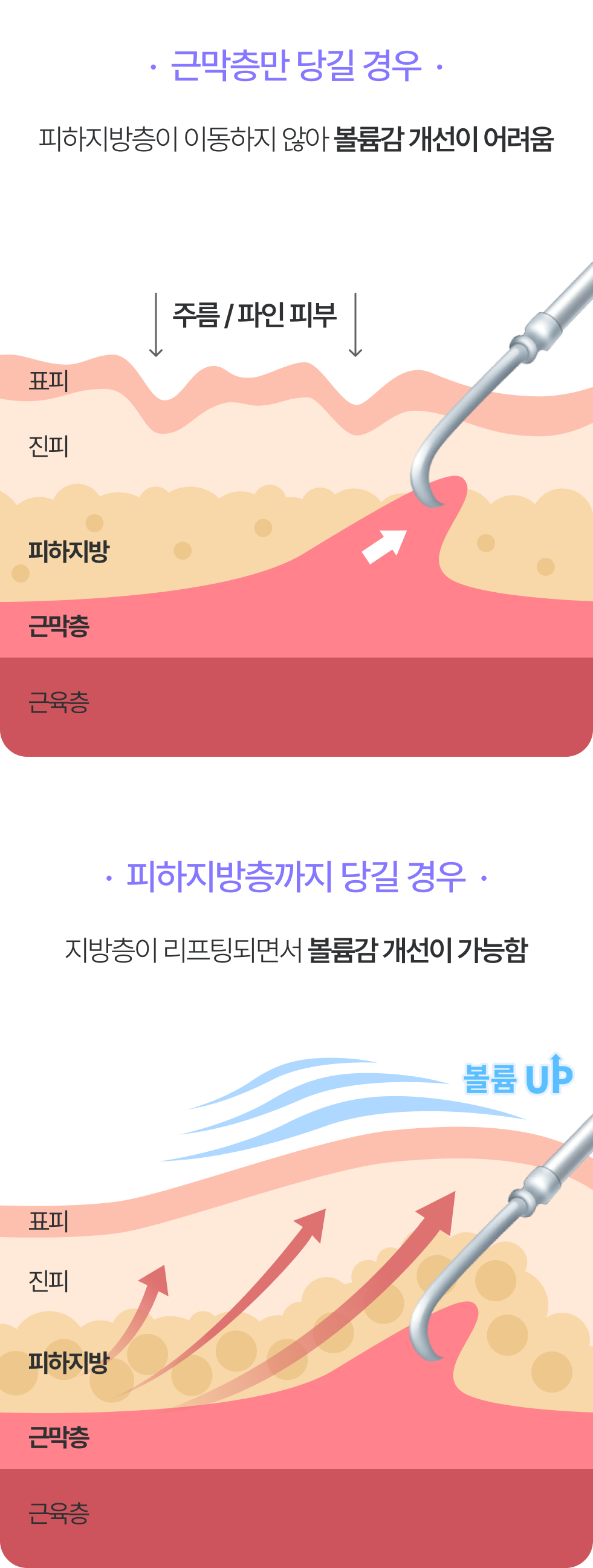 근막층만 당길 경우:피하지방층이 이동하지 않아 볼륨감 개선이 어려움 / 피하지방층까지 당길 경우:지방층이 리프팅되면서 볼륨감 개선이 가능함