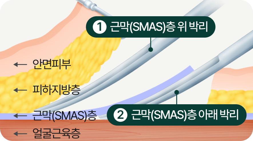 1.근막(SMAS)층 위 박리, 2.근막(SMAS)층 아래 박리