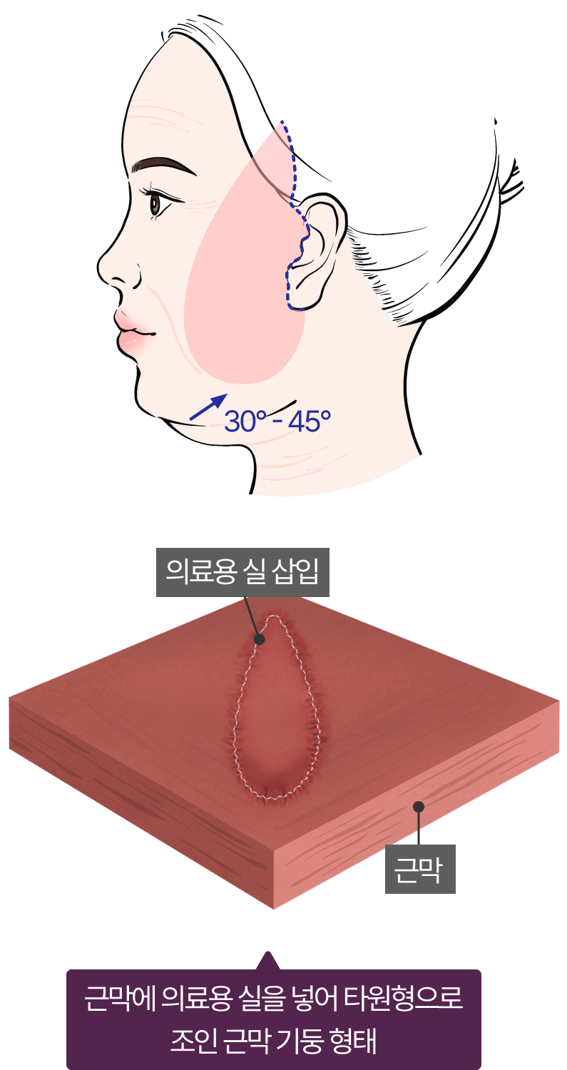 근막에 의료용 실을 넣어 타원형으로 조인 근막 기둥 형태