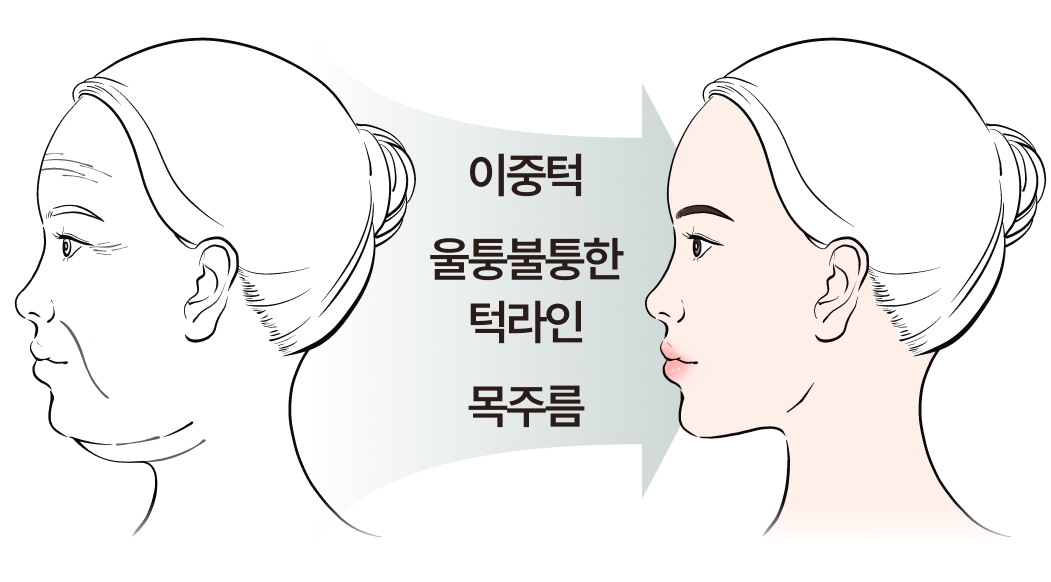 이중턱, 울퉁불퉁한 턱라인, 목주름